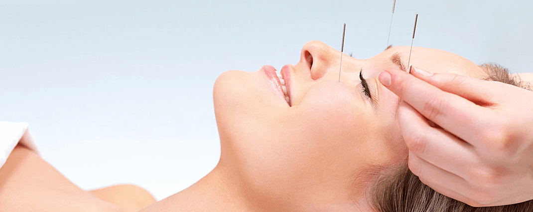 Acupuncture
